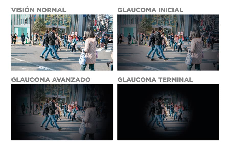 Glaucoma 1